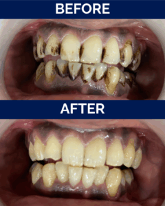 Teeth cleaning and polishin