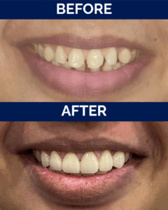 Smile design