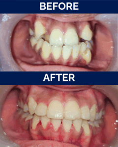 Braces treatment
