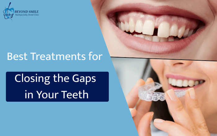 Best Treatments for Closing the Gaps in Your Teeth
