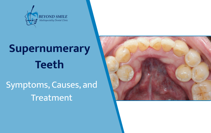 Supernumerary Teeth Symptoms, Causes, and Treatment You Should Know
