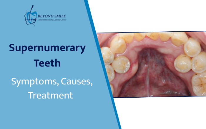 Supernumerary Teeth: Symptoms, Causes, and Treatment You Should Know