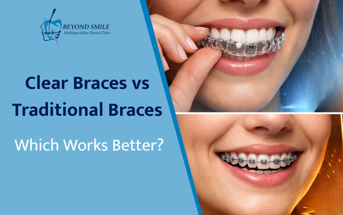 Clear Braces vs Traditional Braces: Which Works Better?